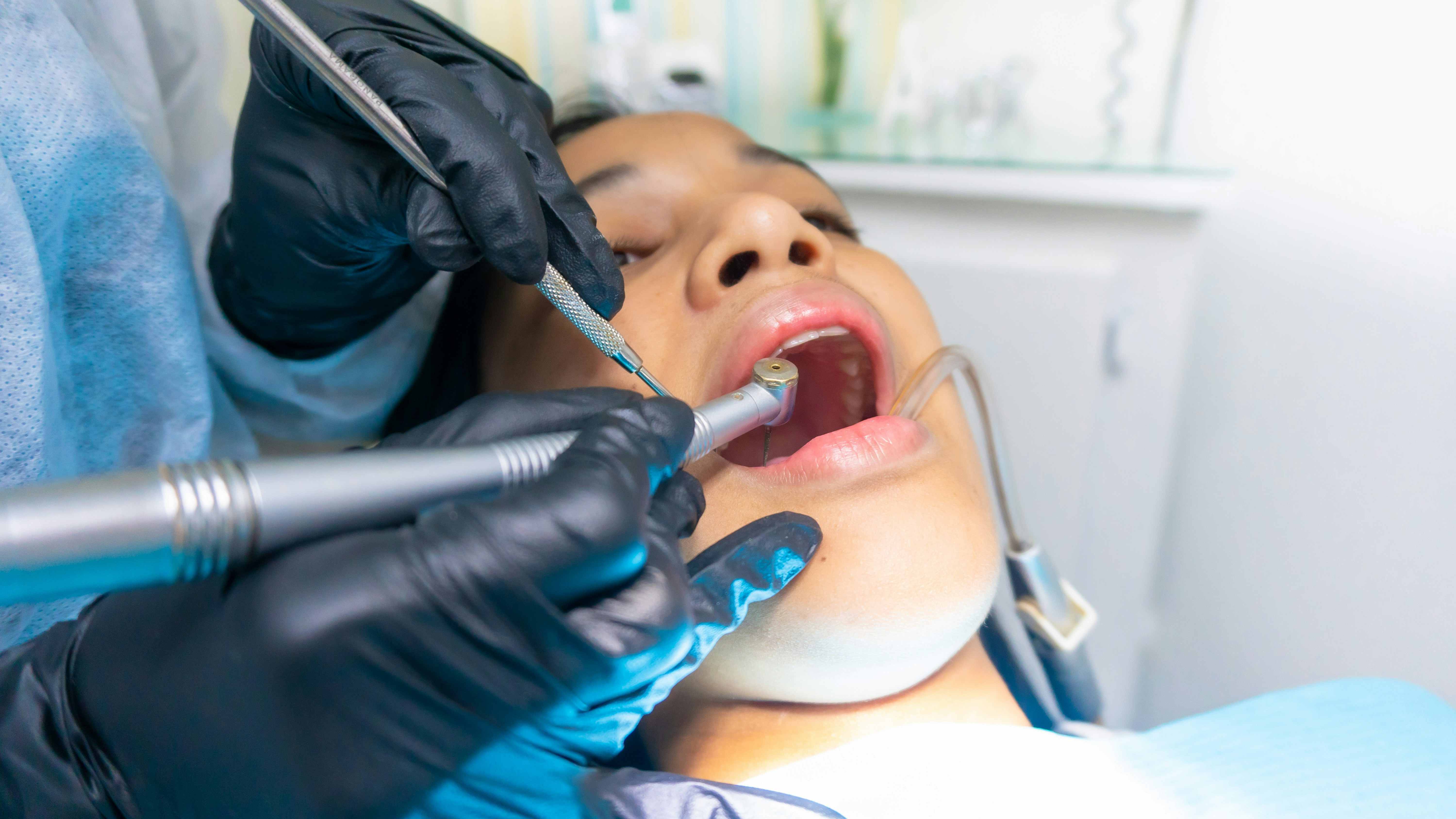 Tooth Extractions