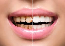 Dental Cleaning (Scaling & Polishing)